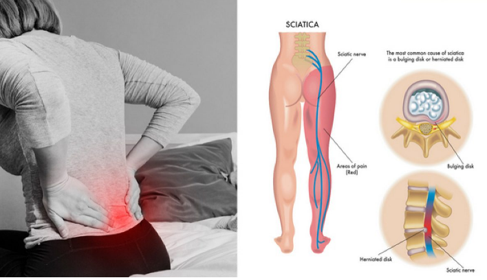 Sciaticyl Sciatigbfdhbfdf